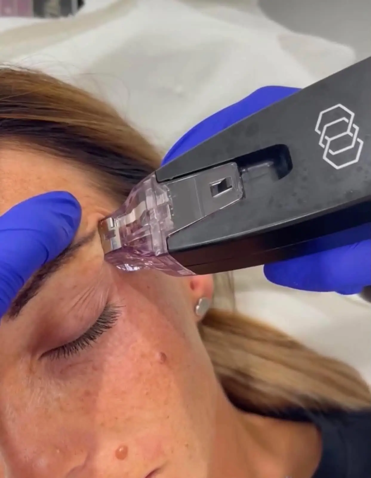 Morpheus8 skin remodelling treatment at Face Medical Aesthetics
