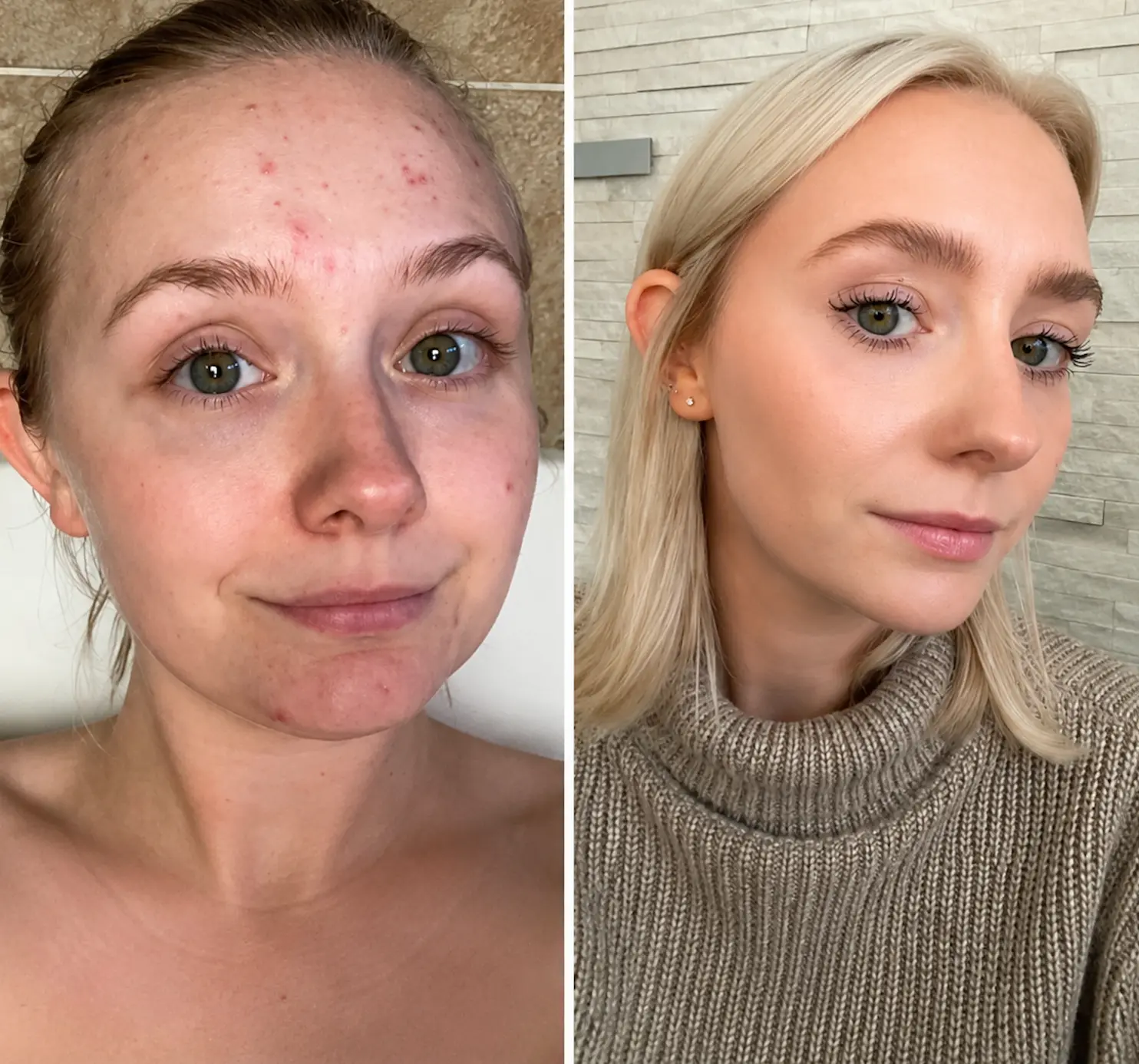 Acne skin transformation before and after result at Face Medical Aesthetics