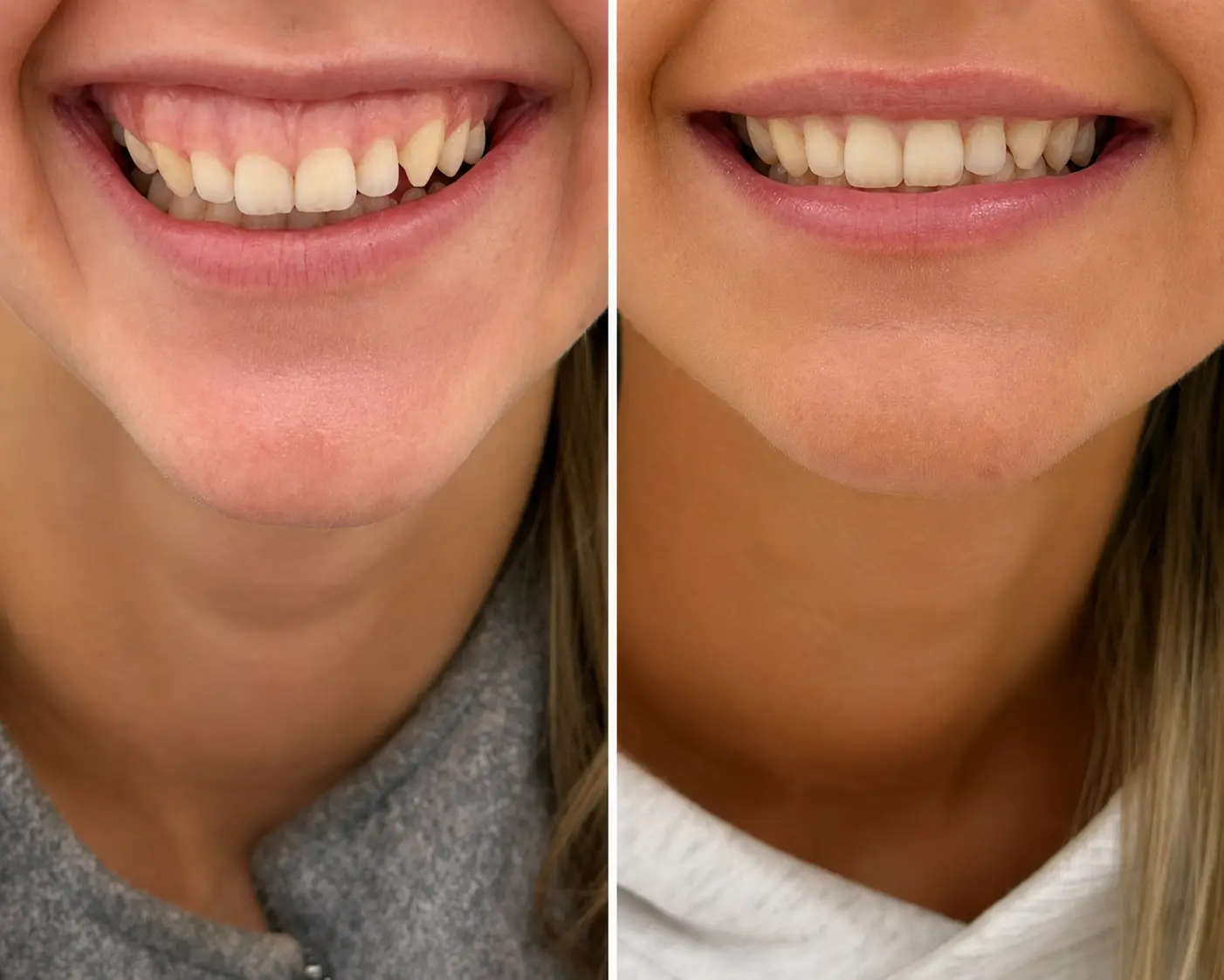 Gummy smile correction before and after result at Face Medical Aesthetics