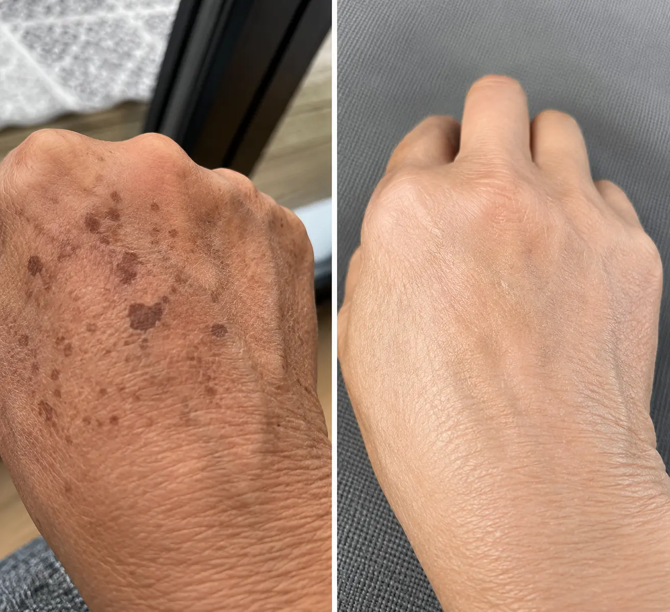 Hand pigmentation reduction before and after result at Face Medical Aesthetics