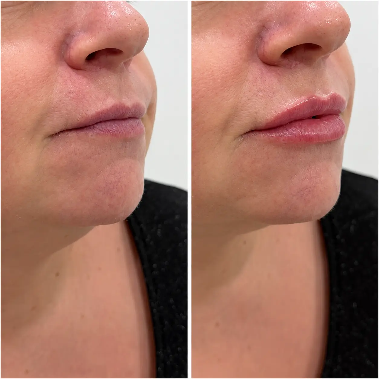 Lip filler before and after treatment result at Face Medical Aesthetics