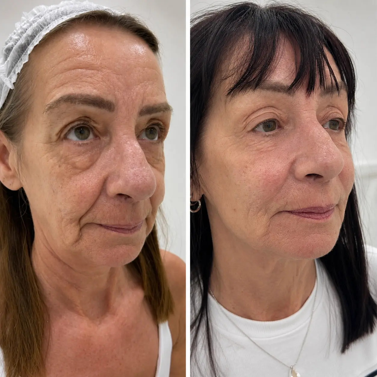 Long-term skin rejuvenation before and after treatment journey at Face Medical Aesthetics